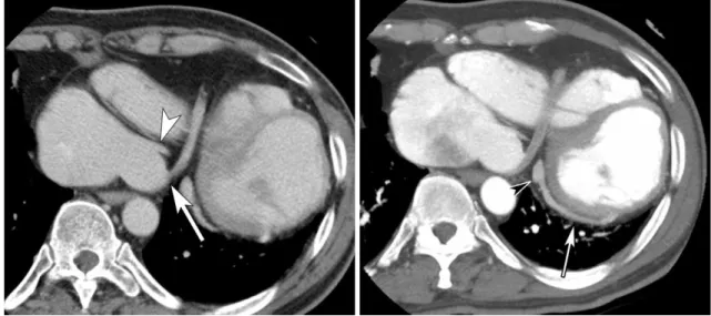 Fig. 3. A. An axial image at the level of the right atrium at venous phase. The drainage of the anomalous vein (arrow) to the right atrium is separate from that of the coronary sinus (arrowhead)