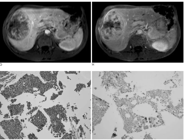 Fig. 1. G, H. Axial, dynamic, contrast-enhanced T1-weighted image shows progressive peripheral enhancement on portal (G) and 5- 5-minute delayed phase (H), whereas the central part of the tumor dose not enhance.