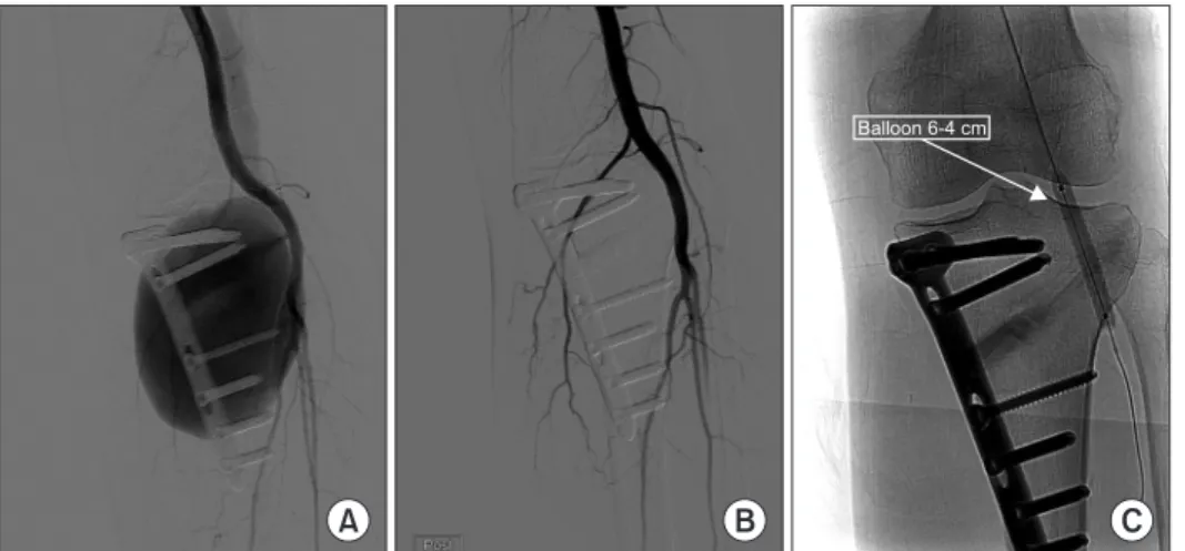Figure 7. Lower extremity angio-computed tomography (CT). One month  after stent implantation