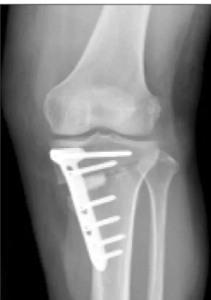 Figure 1. Open wedge high tibial osteotomy performed using a 13 mm  tricalcium phospate block with locking plate.
