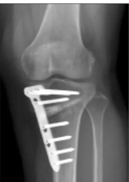 Figure 3. An intraoperative image of the nonunion shown in the wedge  space.