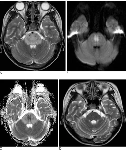 Fig. 5. An 11-year-old male patient with diffuse reversible  leukoen-cephalopathy in the pons.