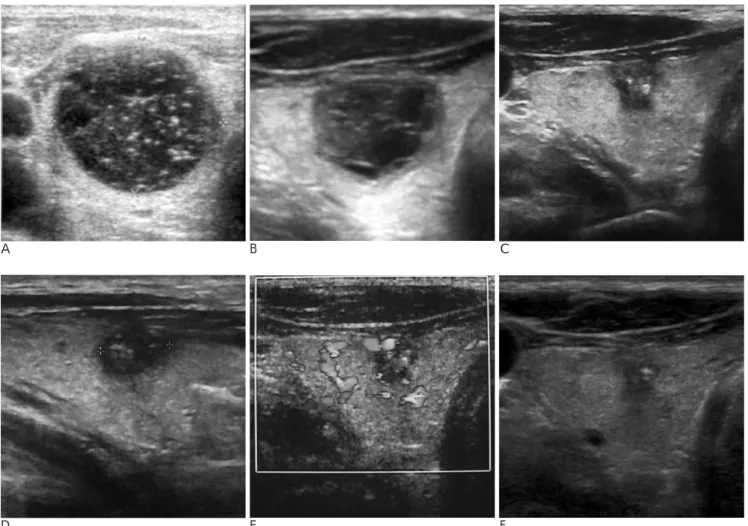 Fig. 1. A 55-year-old man with a cystic thyroid nodule in the right lobe.