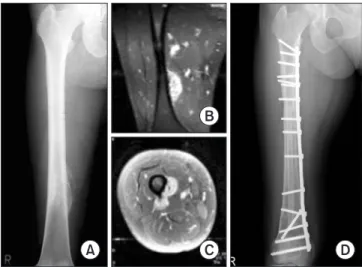 Figure 4. A 40-year-old female patient with parosteal osteosarcoma  at the right distal femur (A–C) was managed with wide resection and  reconstruction with a recycled pasteurized autograft combined with an  inlay type vascularized fibular graft