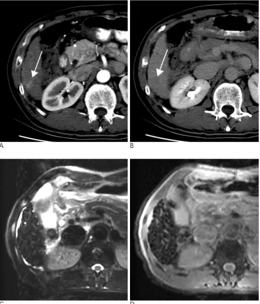 Fig. 1. A 60-year-old-man with a pathologically proven hepatocellular carcinoma in liver segment VI.