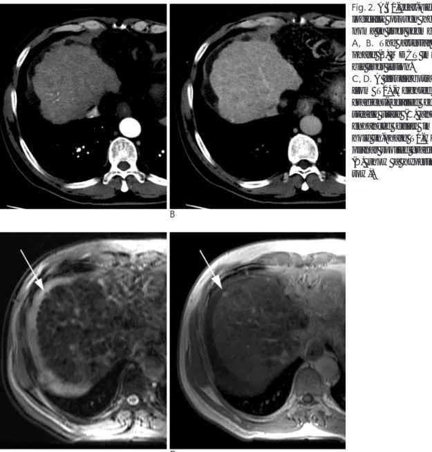 Table 4. Interobserver Agreement Regarding Presence of Hepatocellular Carcinoma