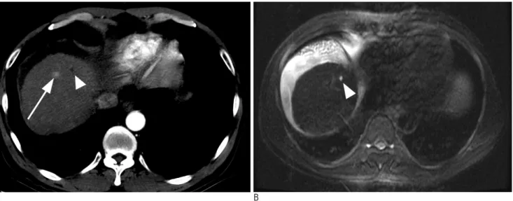 Fig. 4. A 58-year-old man with a false- false-positive lesion on MRI.
