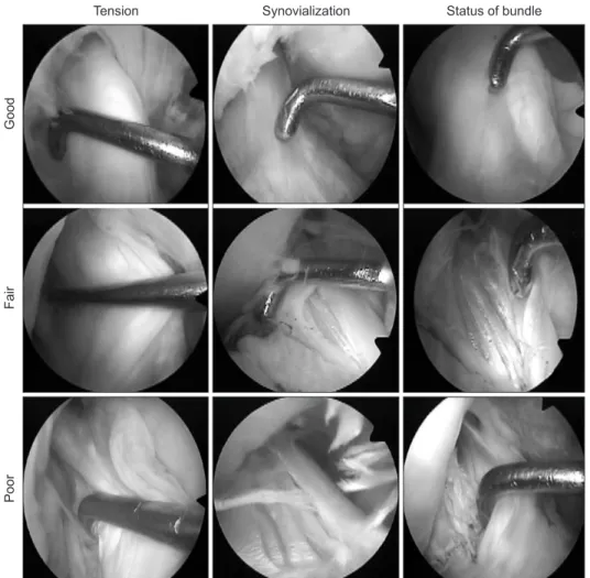 Figure 2. Findings of a second look arth- arth-ro scopy. Tensions of reconstructed grafts  were evaluated subjectively with  meti-culous probing and it was graded as  good, fair, and poor