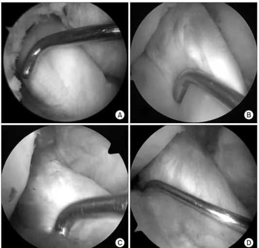 Table 4. Comparison of Graft Tension and Synovial Coverage and  Status of Bundle