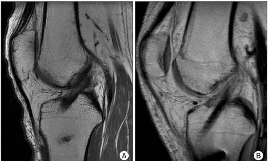 Table 6. Comparison of Signal Intensity of Graft according to Result of  2nd Look Arthroscopy 