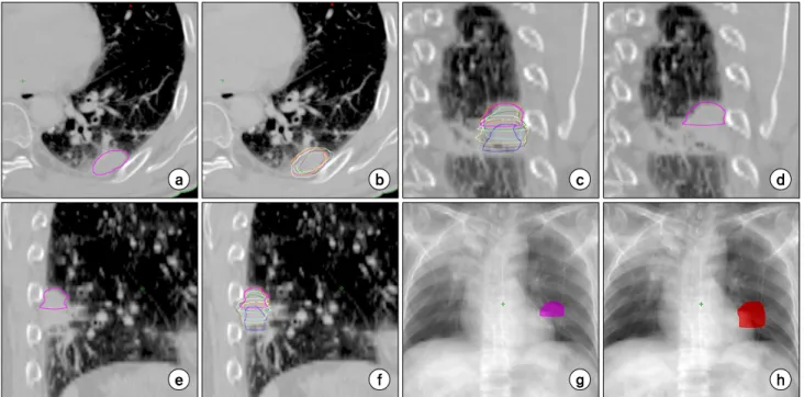 Fig.  2.  CTV 50%   delineated  for  gated  IMRS  and  ITV  based  on  the  CTV i s  in  a  whole  respiratory  phases