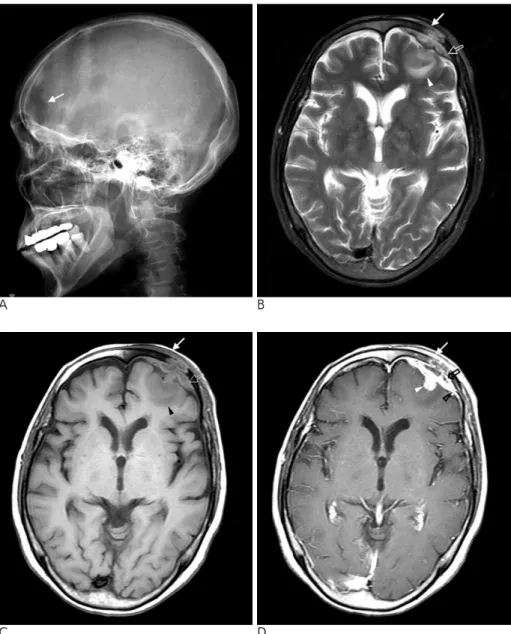 Fig. 1. Simple radiography (A) and magnetic resonance image (B-D).