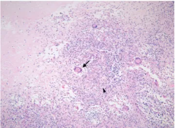 Fig. 2. Microscopic findings (H-E, ×100). Characteristic granu- granu-loma composed of central caseous necrosis surrounding  ep-ithelioid histiocytes (arrow head), multinucleated giant cells (arrow) and lymphocytes is seen