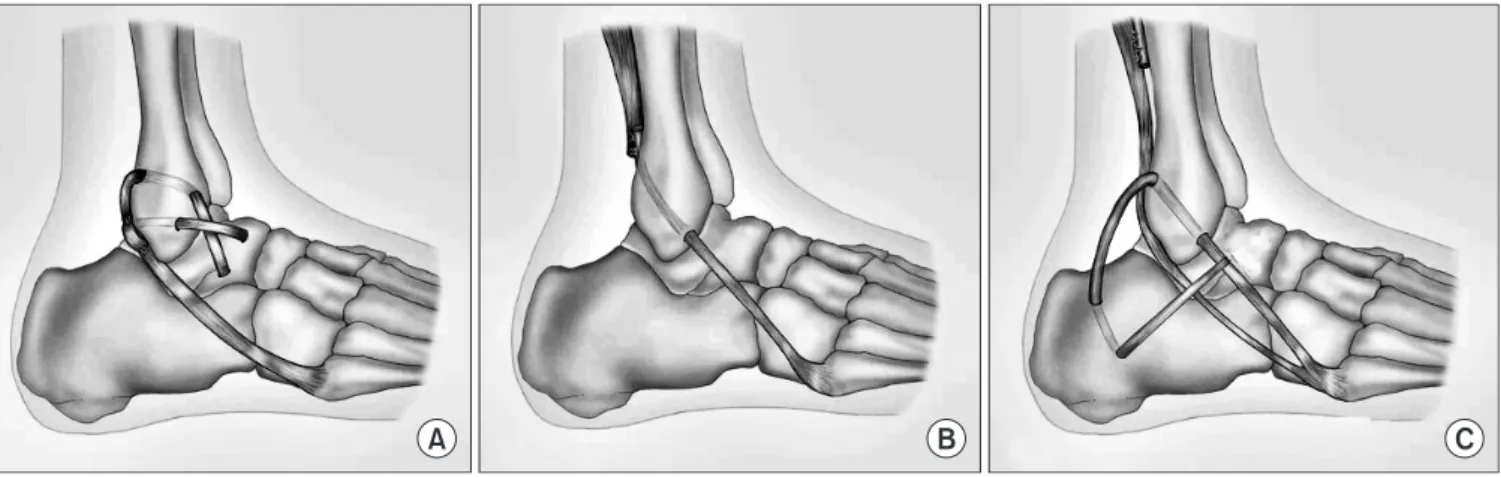 Figure 1. Various techniques of tenodesis for lateral ankle ligament reconstruction. (A) Watson-Jones procedure