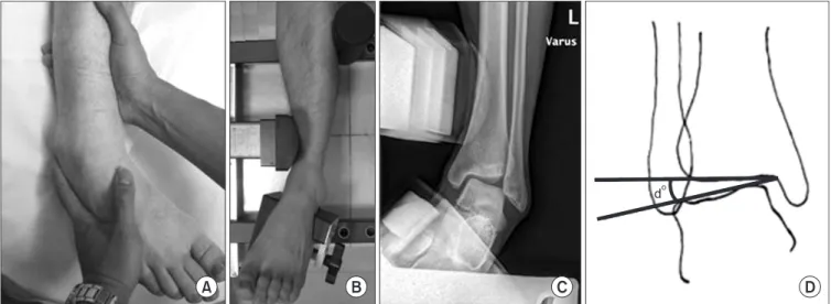 Figure 2. The talar tilt test. (A) Physical examination. (B) Telos in visual. (C) Telos in radiograph