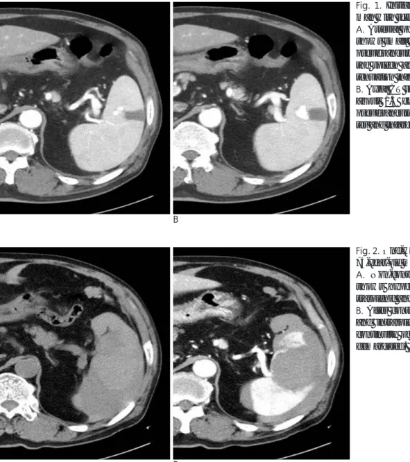 Fig. 1. Initial CT scan of 75-year-old man with scrub typhus. 
