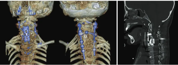 Fig. 7. A. Reformatted 3D volume-rendered images after surgery show the elimination of the vast majority of streak artifacts and clearly delineate the relationship between hardware, bone, and bone fragments