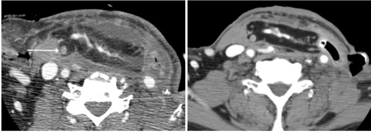 Fig. 3. A 70-year-old man performed total pharyngolaryngectomy, left modified radical neck dissection and reconstruction with je- je-junal free flap due to hypopharynx cancer (T3N0M0)
