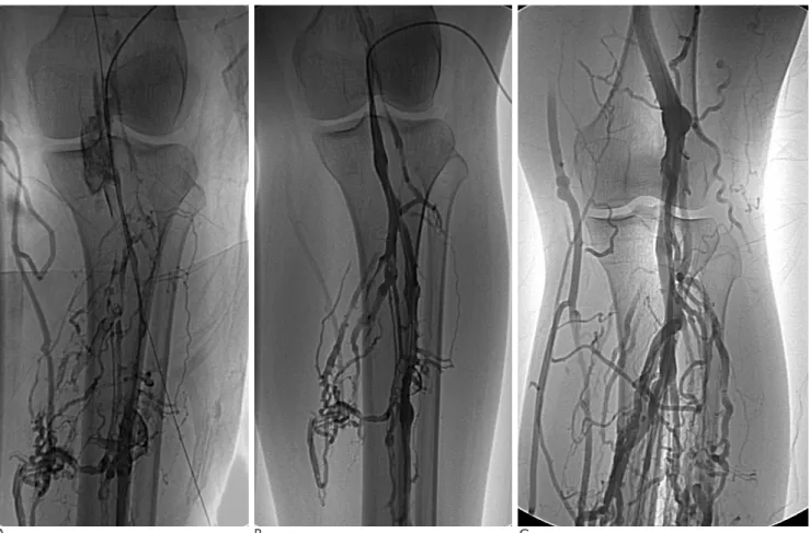 Fig. 1. Deep vein thrombosis of left lower extremity in 48-years-old female.