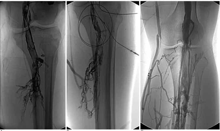 Fig. 2. Deep vein thrombosis of left lower extremity in 30-years-old male.