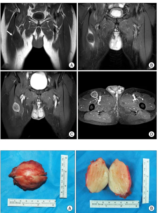 Figure 2. (A) Coronal non-contrast T1- T1-weighted image of the pelvis shows a low  signal intensity mass within the mid portion  of the sartorius muscle measuring 6×5×4  cm in size (arrow)