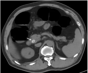 Fig. 1. Symptomatic 76-year old man with major important finding in CT colonography.
