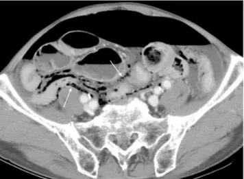 Fig. 4. 5-years-old boy with perforated appendicitis