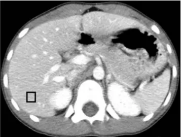 Fig. 1. An abdominal CT image at the level of the celiac axis shows a rectangular region of interest in the posterior segment of the right hepatic lobe used for measuring image noise  (stan-dard deviation of measured CT density).