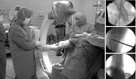 Figure 3. The cable method for assess- assess-ment of intraoperative leg alignassess-ment is  not accurate because it depends on limb  rotation and alignment guide position.