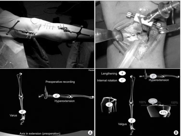 Figure 4. Intraoperative leg alignment measured using a navigation system before (A) and after valgus opening (B)