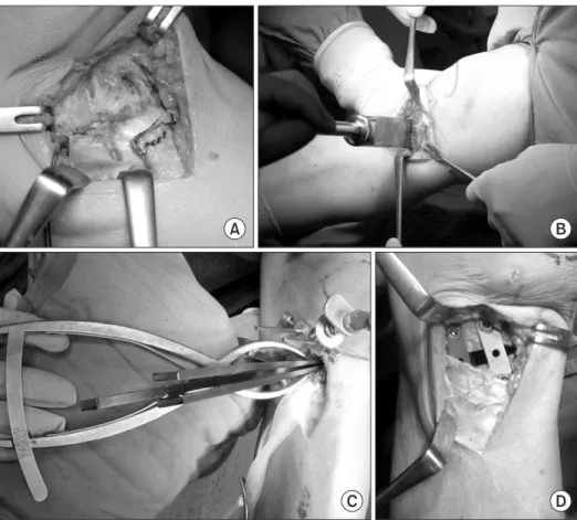 Figure  6.  The  surgical  procedures.  (A)  The Pes anserius was retracted and the  superficial  medial  collateral  ligament  was clearly visualized