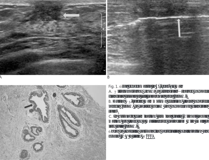 Fig. 1. True gynecomastia in 47-year-old man