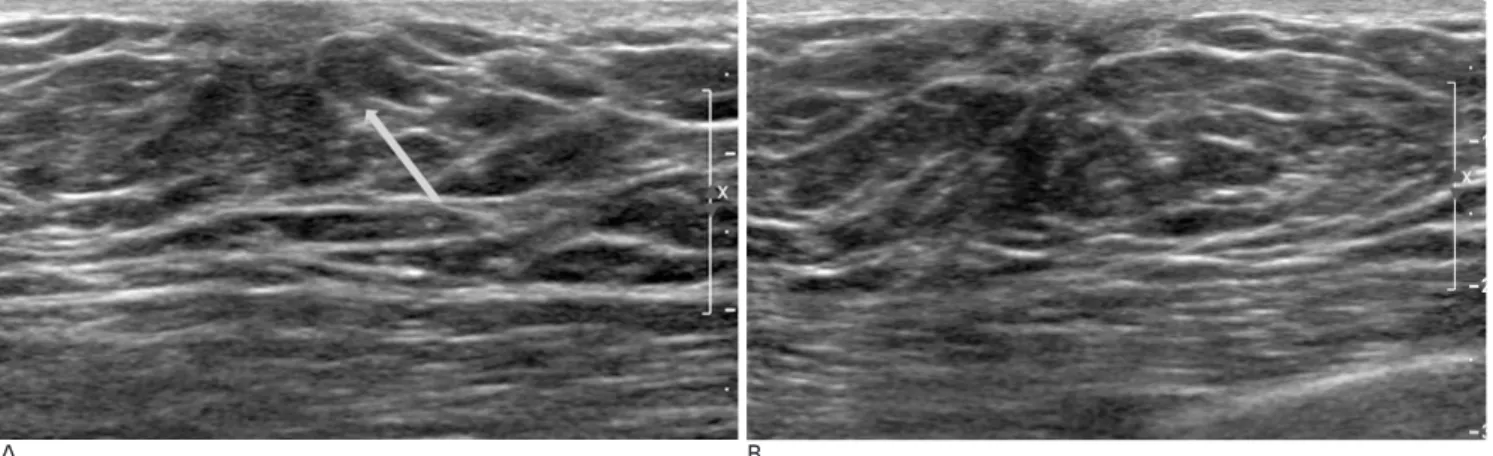 Fig. 3. Pseudogynecomastia in 19-year-old man.