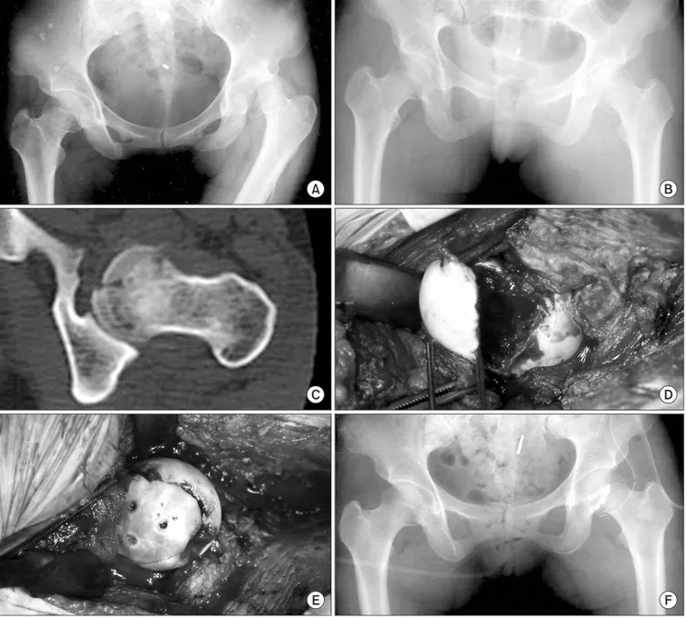 Figure 1. (A) Anteroposterior radiograph of both hips show a Pipkin type I fracture dislocation