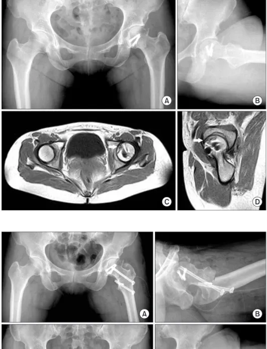 Figure  3.  Immediate  postoperative  anteroposterior  (A)  and  lateral  (B)  radiographs of both hips show the osteomy  site  fixed  with  two  cannulated  screws