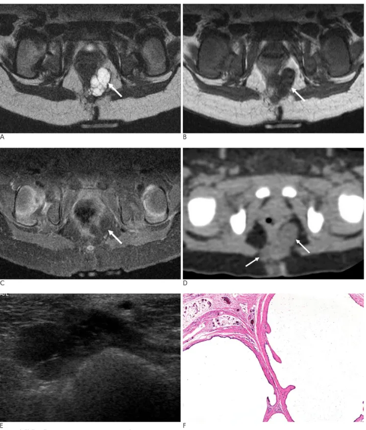 Fig. 1. A 23-day-old neonate with a tailgut cyst.