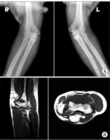 Figure 2. Three types of angular changes  of  the  medial  collateral  ligament. Type  A:  normal  stable  elbow  joint
