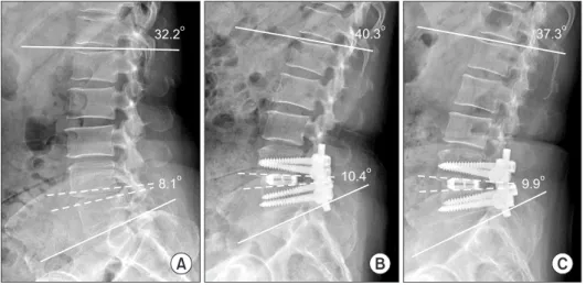 Figure 3. Change of sagittal alignment  after posterior lumbar interbody fusion.  (A)  Preoperative, (B) postoperative (six weeks  after  the  operation),  (C)  final  follow-up  (one year after the operation) lateral x-ray  shows restoration of lumbar lor