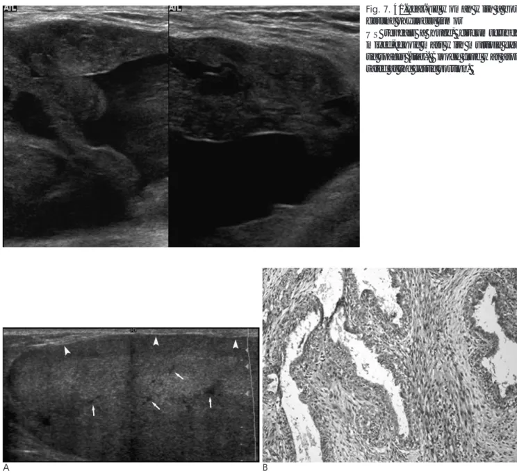 Fig. 7. 41-year-old woman with a bor- bor-derline phyllodes tumor