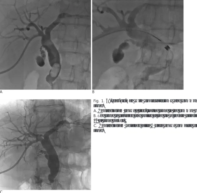 Fig. 1. 68-year-old-man with cholecystectomy and common bile duct stone.
