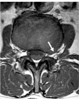 Fig. 2. 34-year-old man with half foraminal and half ex- ex-traforaminal disc herniation