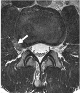 Fig. 4. 67-year-old man with low back pain, left leg pain and numbness. 