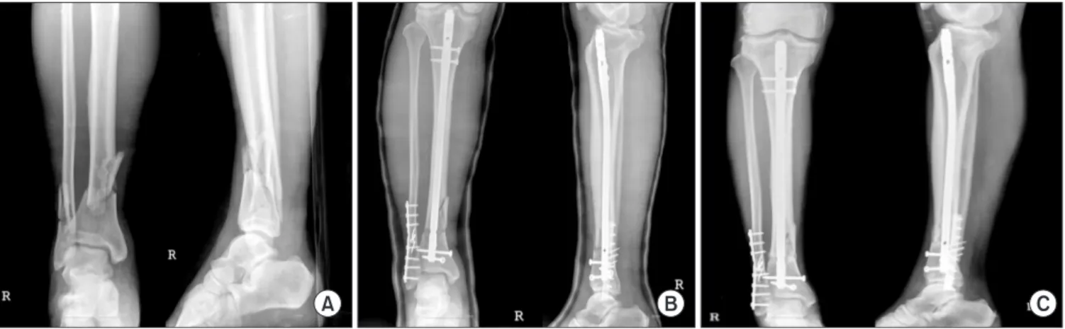 Figure 1. (A) Initial ankle anteroposteroior and lateral radiographs show distal tibio-fibular shaft comminuted fracture