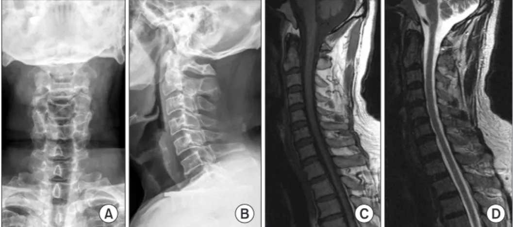 Figure 2. Non-enhanced brain computed  tomography scan showing slightly high- or  iso-density of the bilateral chronic subdural  hematoma, larger on the right.