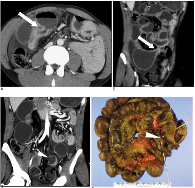 Fig. 1. A-D. Small bowel perforation in a 50 year-old male patient with advanced Crohn’s disease.