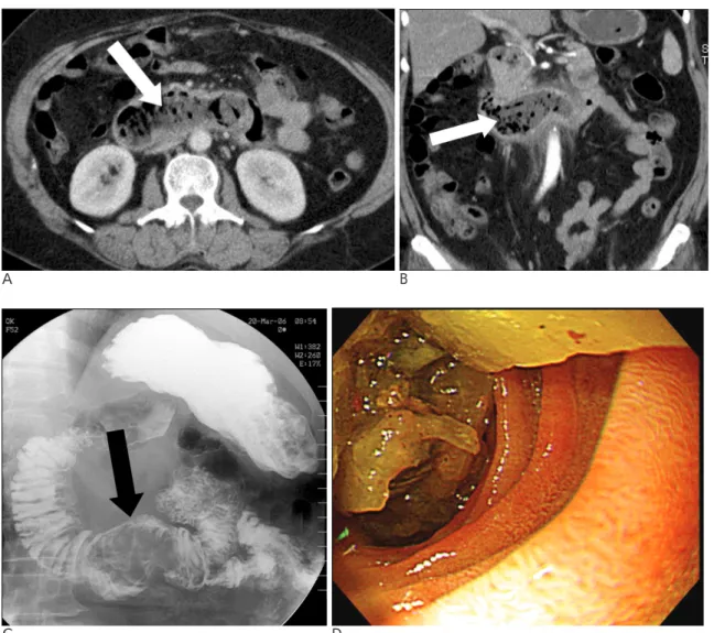 Fig. 5. A-D. Bezoar in the duodenum causing duodenal obstruction in a 66 year-old female patient.