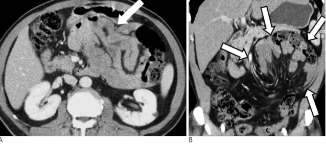 Fig. 8. A-C. Left paraduodenal hernia presenting in a 54 year-old male patient with vomiting symptoms