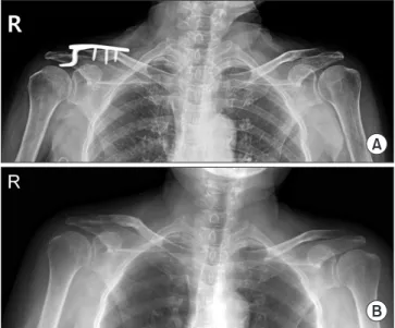 Figure 4. Korean Shoulder Scoring System (KSS) score. SD: standard  deviation. 