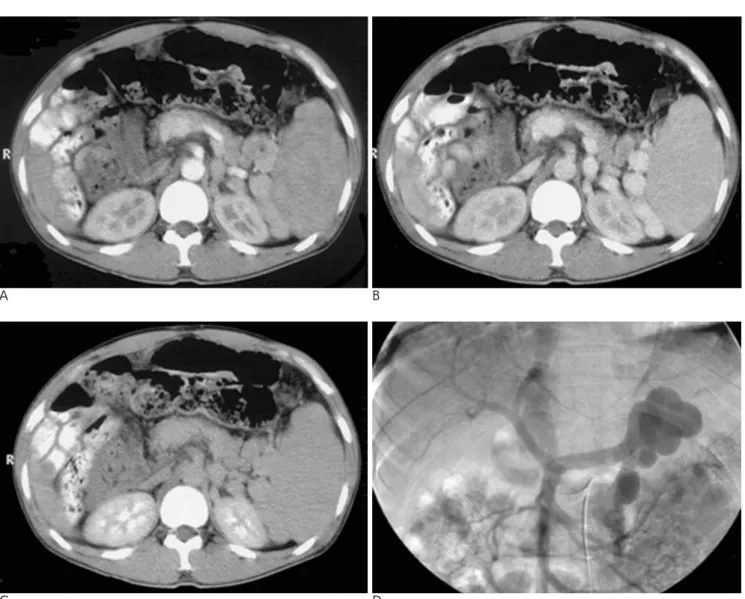 Fig. 3. A three-phase CT scan (A-arterial phase, B-portal phase, C-delayed phase) and arterial-portography (D) performed in a pa- pa-tient with a renal shunt