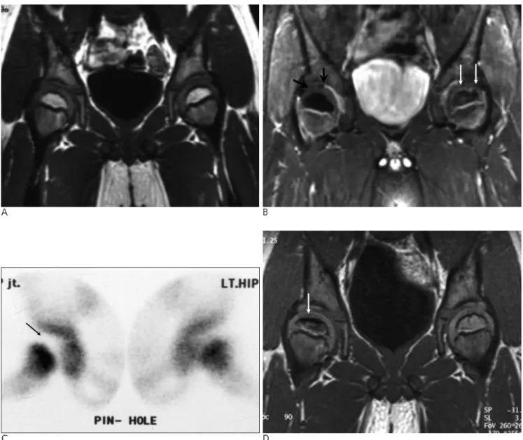 Fig. 2. Right side early LCP in a 4-year-old boy with right hip pain